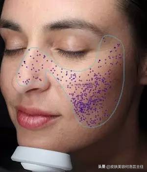 visia皮肤检测是什么原理,visia皮肤检测值多少是正常的