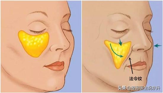 学会这些小技巧法令纹统统不见,怎么去法令纹中的表情纹