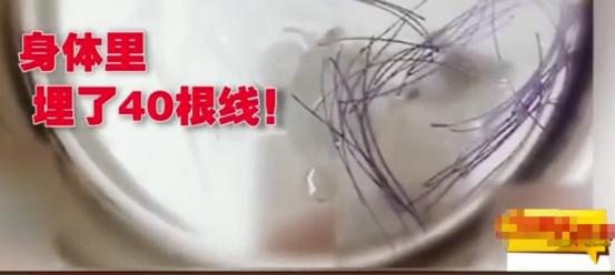 女子面部整形后差点丧命,女子做了一个可怕的整形手术