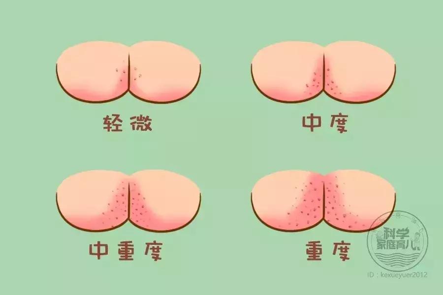 错不起！3岁女宝得妇科病？男女宝洗护差异大，别踩雷！