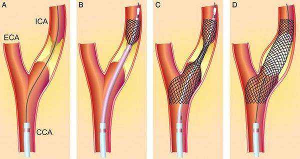 颈部血管有斑块需要怎么处理,颈部血管有斑块可以怎么治疗
