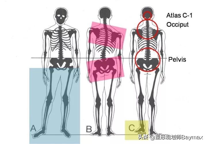 高低胯引起的长短腿,高低肩长短腿容易发生什么病