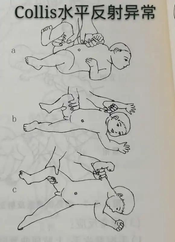 脑瘫儿童的七种异常姿势,判断宝宝脑瘫最简单的方法