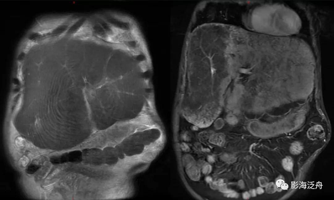 肝脏弥漫性病变严重吗,肝脏弥漫性的病变的症状