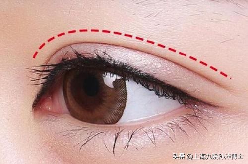 修复双眼皮眼角有分叉怎么办,双眼皮修复折痕分叉