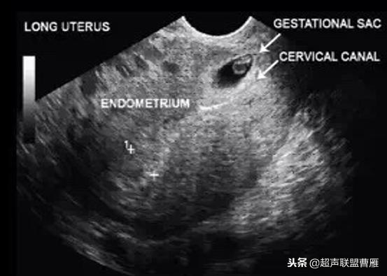 剖宫产疤痕妊娠动画,剖宫产疤痕妊娠的临床分型