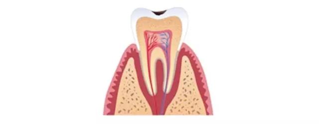 补牙补到牙齿都秃没了,补牙快到牙神经了补完咬合疼