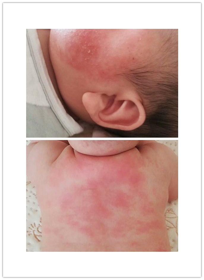 一个月婴儿湿疹用什么面霜,宝宝湿疹可以擦金银花多效面霜吗