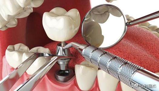 种牙保险有没有推荐,植牙保险怎么买