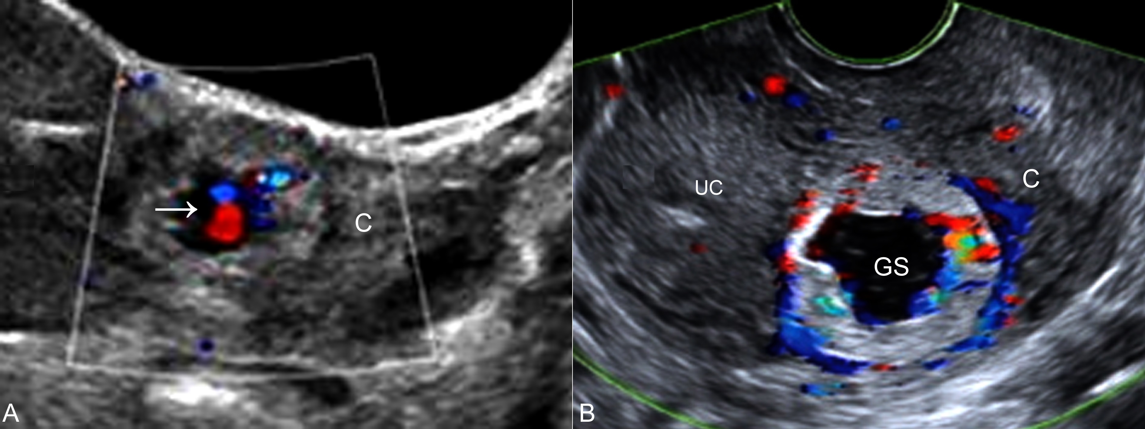 明明白白做超声,肌壁间妊娠和间质部妊娠怎么鉴别
