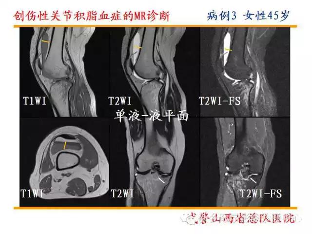 膝关节炎髌上囊积液自己看得出吗,髌上囊有积液膝盖会走路无力吗