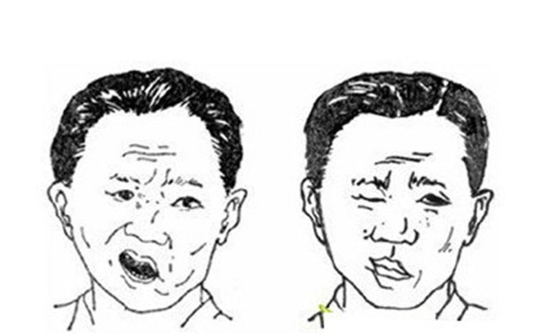 面瘫吃什么菜对面瘫恢复有帮助,面瘫常见的几个问题