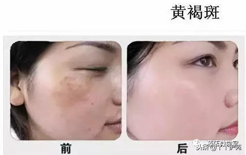 褐斑特效药,褐斑吃什么药比较好