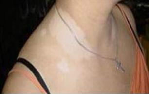 不要这样“变美”：22岁女孩为美白进行代购，因使用不当患白癜风