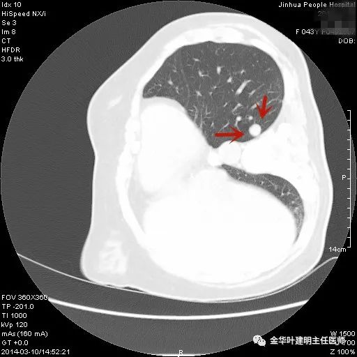 叶建明谈胸膜下的实性结节,叶建明肺实性良性结节会变癌症吗