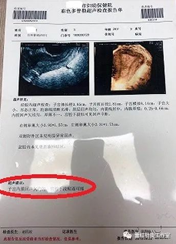 多囊卵巢综合征患者能自然怀孕吗？