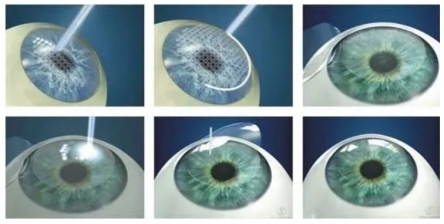 小孩近视1000多度怎么恢复视力,儿童视力检查费用一般多少