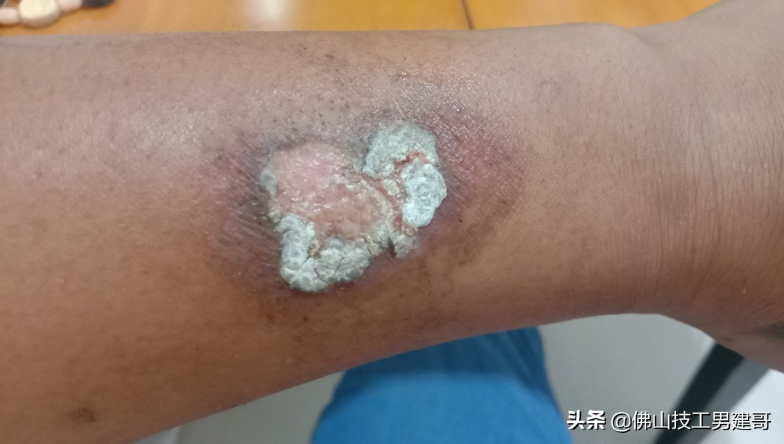 手部烫伤后的康复视频,手烫伤处理视频