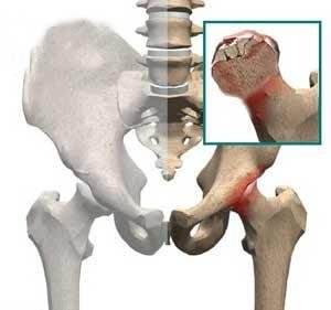 儿童股骨头坏死属于什么科,股骨头缺血性坏死一期应注意什么