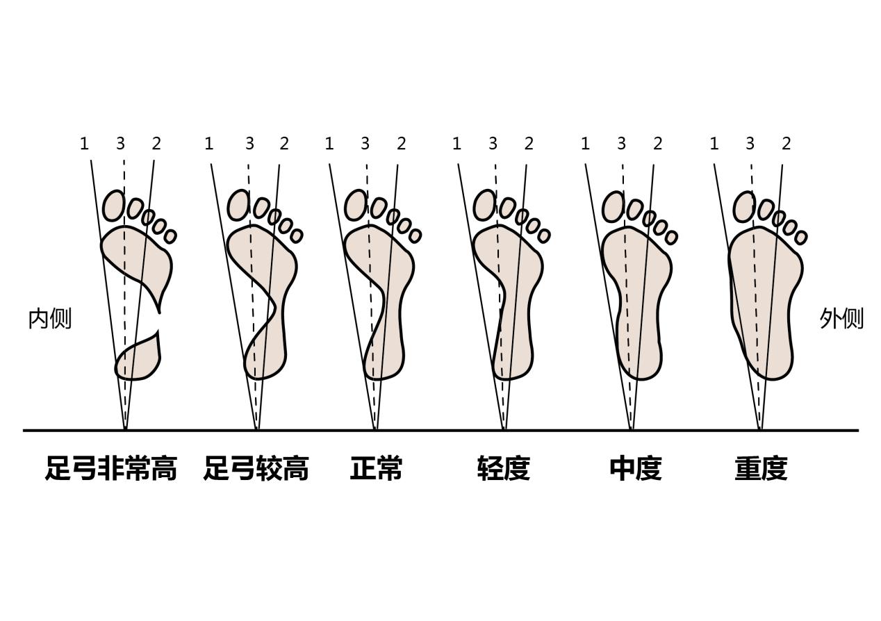 足弓塌陷会导致脚后跟疼吗,足弓和脚后跟痛怎么回事