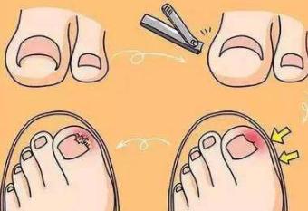 嵌甲一直不剪会怎么样,嵌甲习惯长在肉里纠正不过来