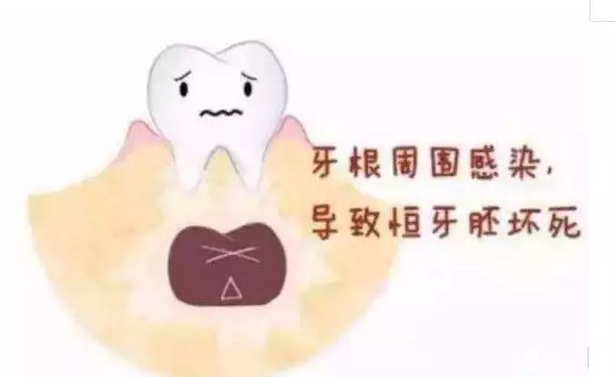 做了窝沟封闭还会蛀牙,蛀齿还需要做窝沟封闭吗