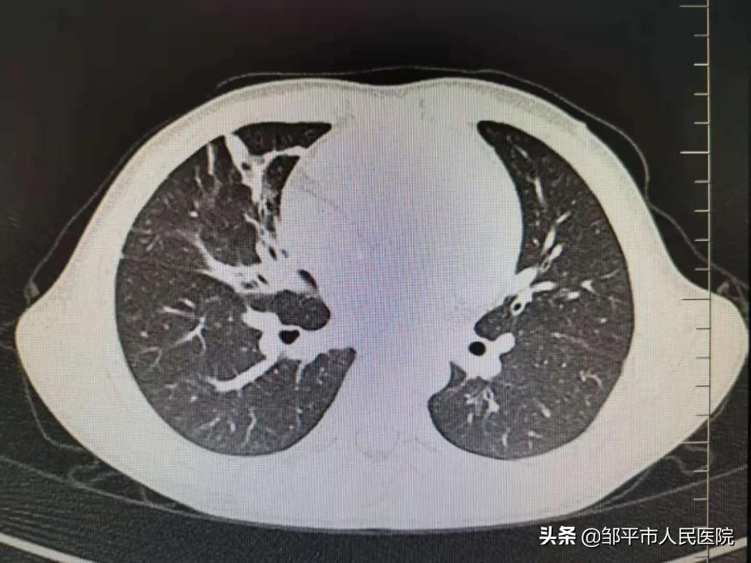 重症肺炎最佳治疗方法,满月宝宝重症肺炎如何治疗