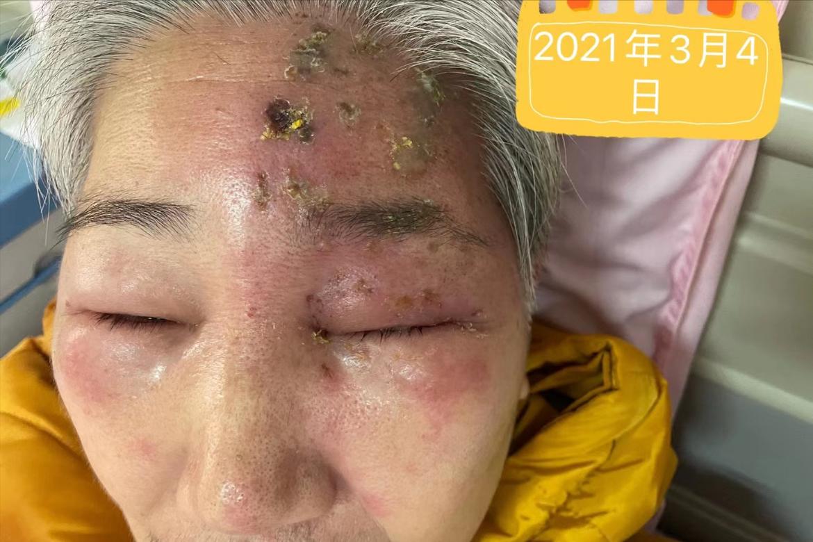 带状疱疹吃中药好还是西药好,带状疱疹后遗神经痛的中药方