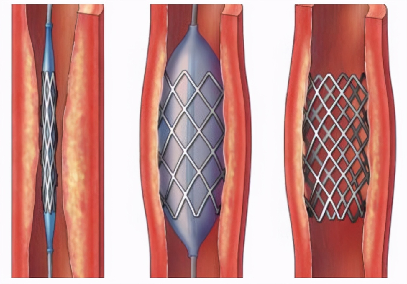 打击天价医药,中国的天价药没人管吗