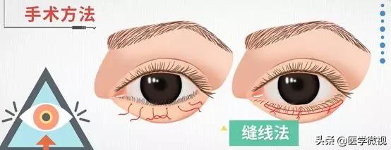 睫毛长倒睫怎么办,睫毛倒长扎眼睛怎么处理