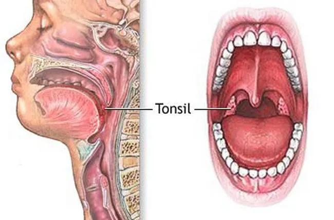 小孩子扁桃体发热,小孩发热扁桃体有白点用啥药