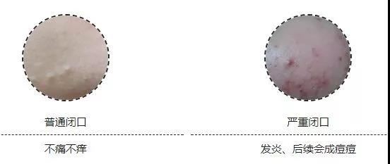 满脸都是闭口,满脸都是闭口的状态