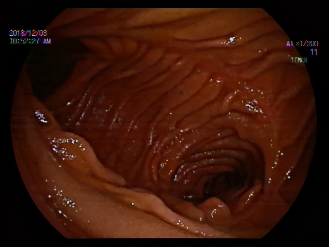 八年胆汁流通不畅，老奶奶成了“小黄人”……