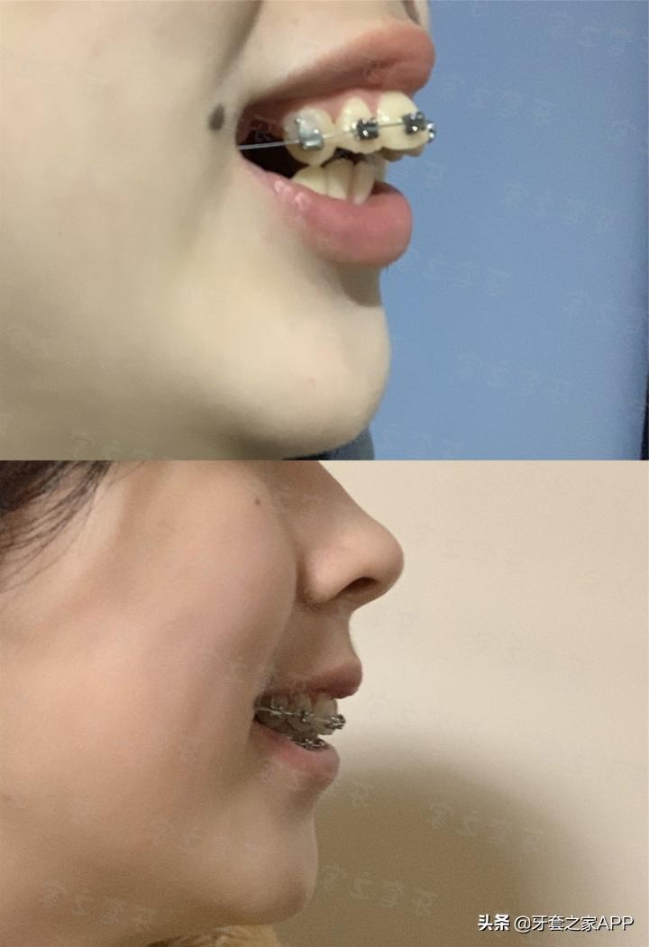 不靠整容怎么改变下巴后缩？看这里