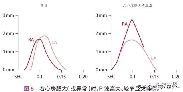 左、右心房肥大/异常「11」