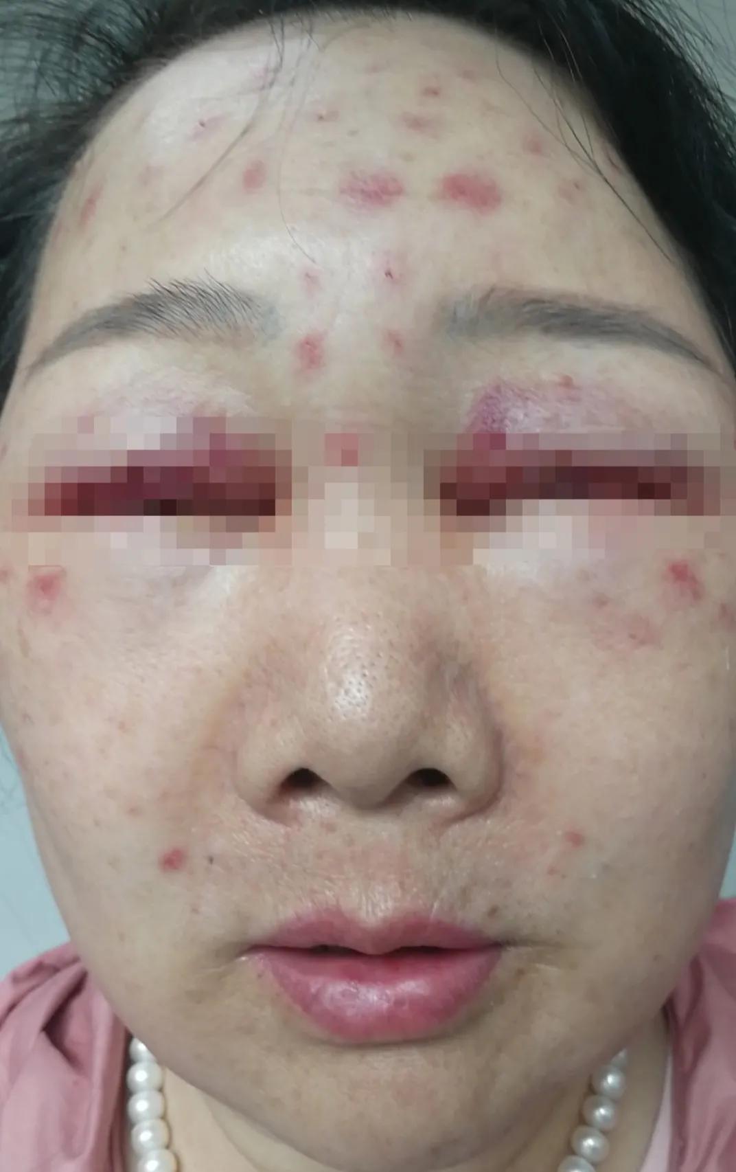 一次水光针需要2000多针吗,一次水光针等于100片面膜