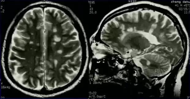 脱髓鞘病变是什么病怎么读,脱髓鞘病变的特征