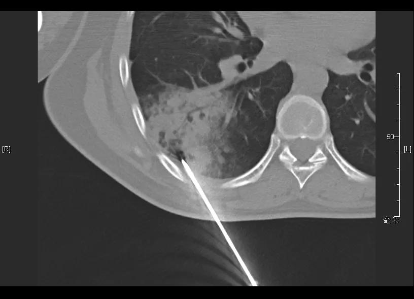 机化性肺炎必须病理确诊吗,机化性肺炎好转的征兆