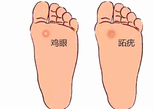 切记不要把跖疣当作鸡眼处理,跖疣和鸡眼到底怎么区分