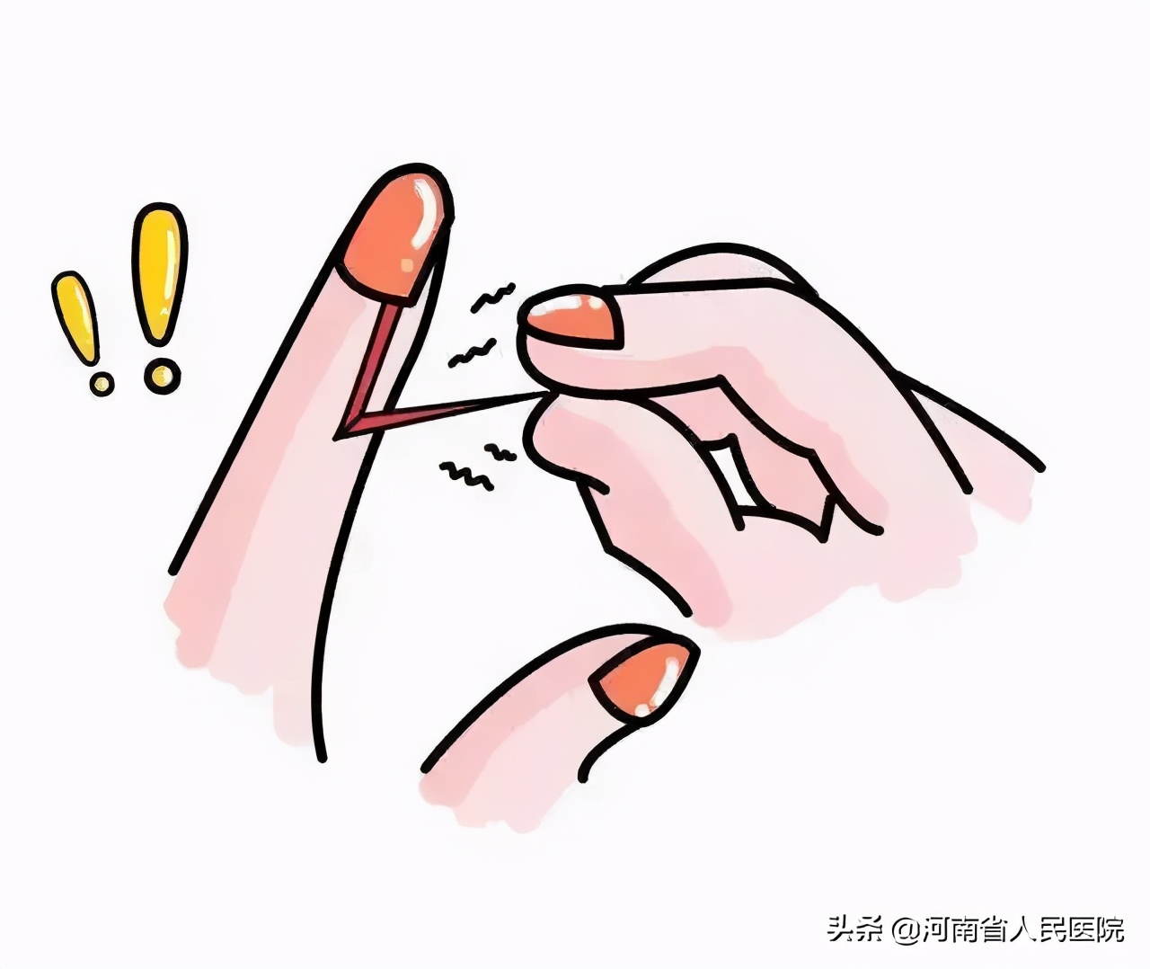 指甲往肉里长怎么根治视频,指甲老是往肉里面长怎么矫正