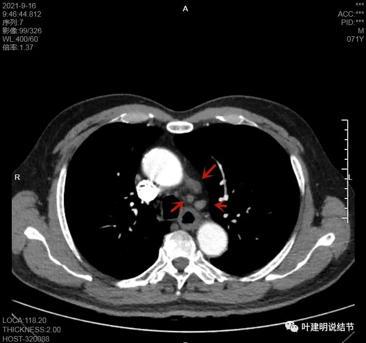 肺上有实性结节6mmx5mm是什么原因,肺上有1.7x1.8的实性结节该怎么办