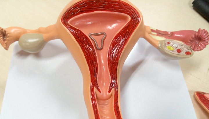 避孕环、节育环、宫内节育器,到底是个啥?