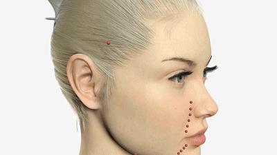 常见的除皱术有什么,扒一扒生活中祛痘方法和注意事项