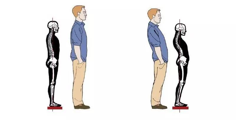 膝反屈的治疗方法,膝反屈是什么意思