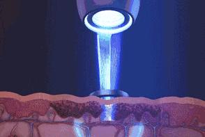 超皮秒避坑,超皮秒祛斑适合角质层薄的人