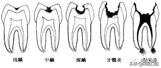 牙齿蛀牙多久会完全蛀掉,牙齿被虫蛀空了怎么修补