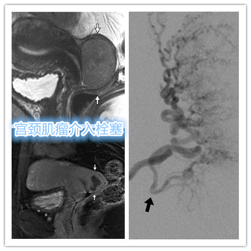子宫肌瘤介入栓塞造影剂作用,子宫肌瘤介入栓塞有副作用吗