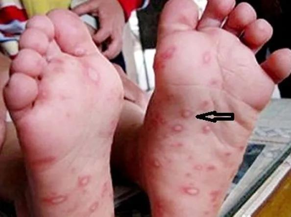 鎵嬭冻鍙ｇ梾棰勯槻瑙嗛鍔ㄧ敾,棰勯槻鎵嬭冻鍙ｇ梾瀹夊叏鏁欒偛