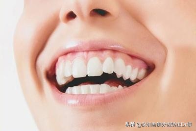 露龈笑怎么办,露龈笑矫正