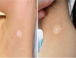 6岁儿童白癜风吃什么好得快,不吃蔬菜的小孩白癜风